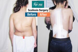 Scoliosis Treatment in India